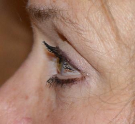 eyelid surgery in miami