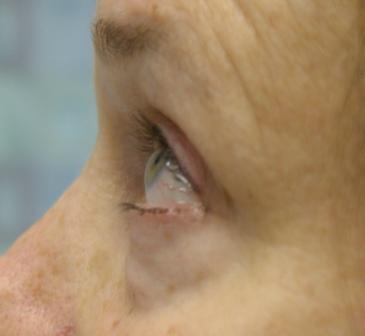 eyelid surgery in miami