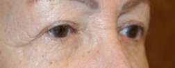 eyelid surgery in miami