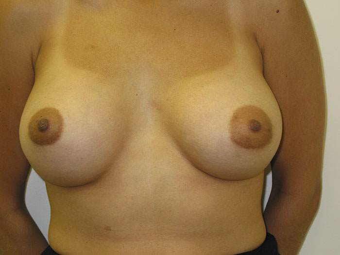 breast lift in miami