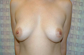 breast lift in miami