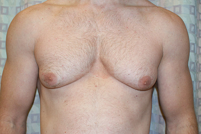 miami breast augmentation