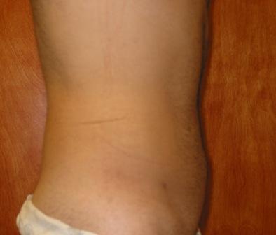 tummy tuck in miami