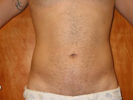 tummy tuck in miami
