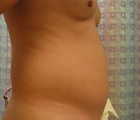 tummy tuck in miami