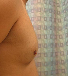 miami breast augmentation
