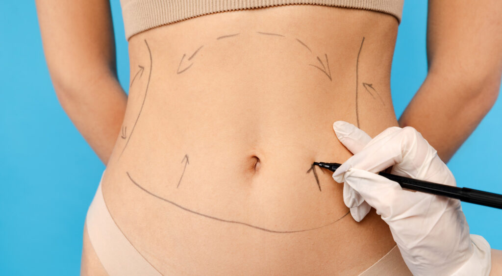 Extended Tummy Tuck​