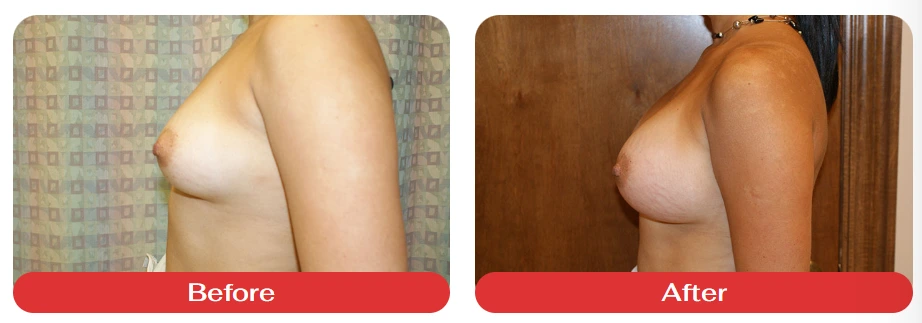 Breast augmentation before and after photos