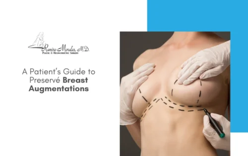 guide-to-preserve-breast-augmentations