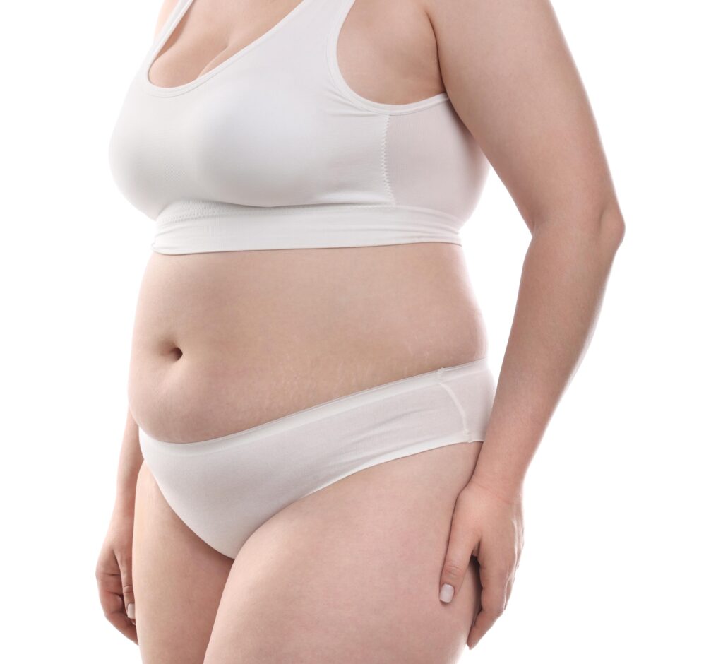 Plus-Size Tummy Tuck​