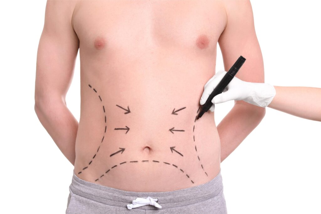 What is Tummy Tuck Surgery for Men?​