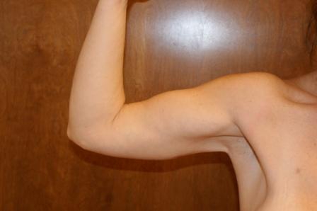 After photo of Arm Lift case 2 by Dr. Ramiro Morales, plastic surgeon in Miami, FL