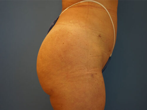 After photo of Brazilian Butt Lift case 1 by Dr. Ramiro Morales, plastic surgeon in Miami, FL