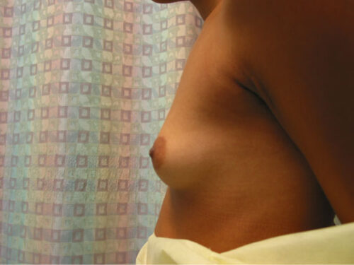 Before photo of Breast Augmentation case 10 by Dr. Ramiro Morales, plastic surgeon in Miami, FL