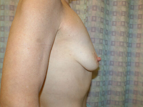 Before photo of Breast Augmentation case 11 by Dr. Ramiro Morales, plastic surgeon in Miami, FL