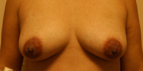 Before photo of Breast Augmentation case 14 by Dr. Ramiro Morales, plastic surgeon in Miami, FL