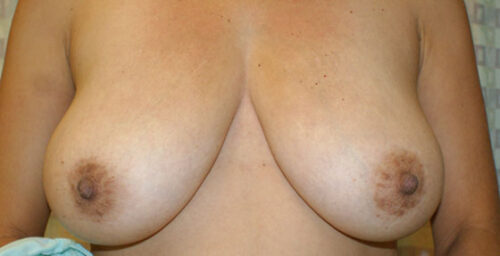 Before photo of Breast Lift case 4 by Dr. Ramiro Morales, plastic surgeon in Miami, FL