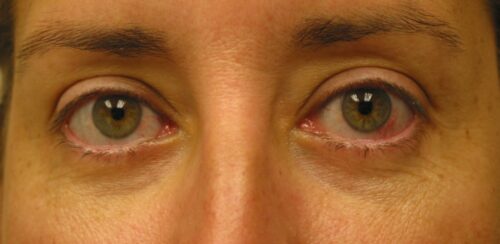 After photo of Eyelid Surgery (Blepharoplasty) case 1 by Dr. Ramiro Morales, plastic surgeon in Miami, FL