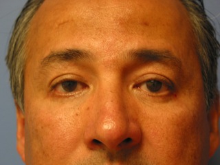 After photo of Eyelid Surgery (Blepharoplasty) case 2 by Dr. Ramiro Morales, plastic surgeon in Miami, FL
