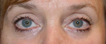 After photo of Eyelid Surgery (Blepharoplasty) case 3 by Dr. Ramiro Morales, plastic surgeon in Miami, FL