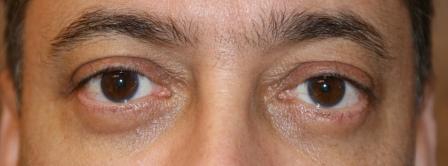 After photo of Eyelid Surgery (Blepharoplasty) case 4 by Dr. Ramiro Morales, plastic surgeon in Miami, FL