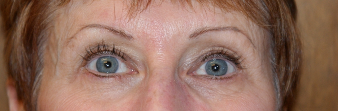 After photo of Eyelid Surgery (Blepharoplasty) case 5 by Dr. Ramiro Morales, plastic surgeon in Miami, FL