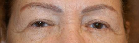 After photo of Eyelid Surgery (Blepharoplasty) case 6 by Dr. Ramiro Morales, plastic surgeon in Miami, FL
