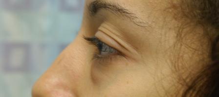Before photo of Eyelid Surgery (Blepharoplasty) case 7 by Dr. Ramiro Morales, plastic surgeon in Miami, FL