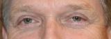 After photo of Eyelid Surgery (Blepharoplasty) case 8 by Dr. Ramiro Morales, plastic surgeon in Miami, FL