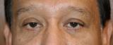After photo of Eyelid Surgery (Blepharoplasty) case 9 by Dr. Ramiro Morales, plastic surgeon in Miami, FL