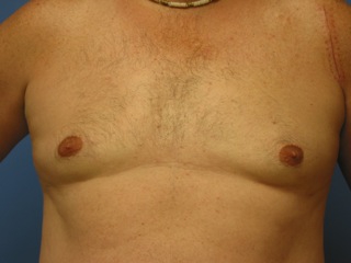 After photo of Gynecomastia (Male Breast Reduction) case 1 by Dr. Ramiro Morales, plastic surgeon in Miami, FL