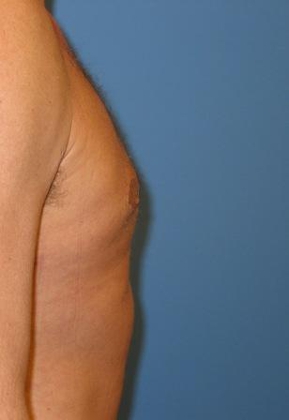 After photo of Gynecomastia (Male Breast Reduction) case 2 by Dr. Ramiro Morales, plastic surgeon in Miami, FL