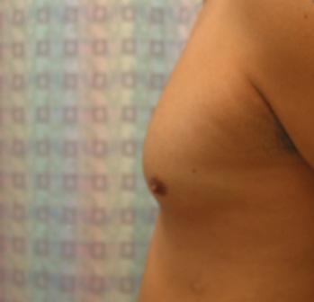 After photo of Gynecomastia (Male Breast Reduction) case 3 by Dr. Ramiro Morales, plastic surgeon in Miami, FL