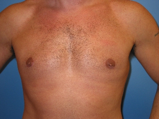 After photo of Gynecomastia (Male Breast Reduction) case 4 by Dr. Ramiro Morales, plastic surgeon in Miami, FL