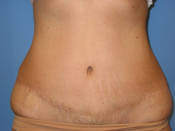 After photo of Tummy Tuck (Abdominoplasty) case 1 by Dr. Ramiro Morales, plastic surgeon in Miami, FL