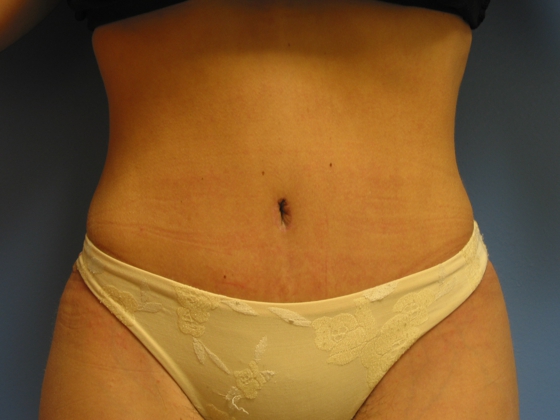 After photo of Tummy Tuck (Abdominoplasty) case 2 by Dr. Ramiro Morales, plastic surgeon in Miami, FL