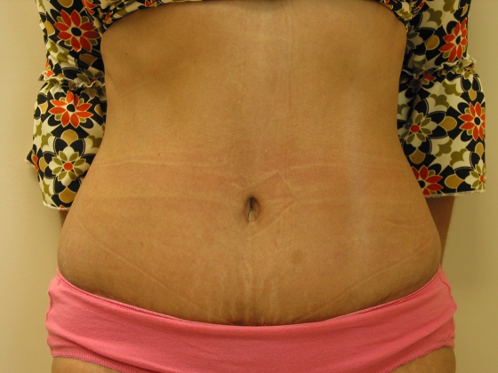 After photo of Tummy Tuck (Abdominoplasty) case 3 by Dr. Ramiro Morales, plastic surgeon in Miami, FL