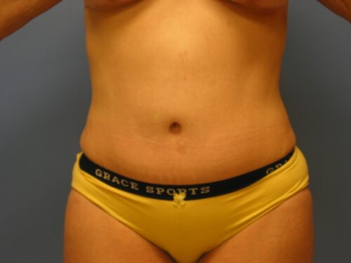 After photo of Tummy Tuck (Abdominoplasty) case 4 by Dr. Ramiro Morales, plastic surgeon in Miami, FL