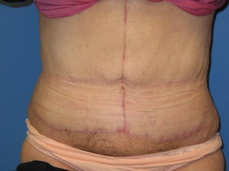 After photo of Tummy Tuck (Abdominoplasty) case 5 by Dr. Ramiro Morales, plastic surgeon in Miami, FL