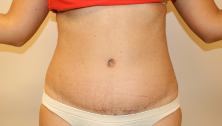 After photo of Tummy Tuck (Abdominoplasty) case 6 by Dr. Ramiro Morales, plastic surgeon in Miami, FL