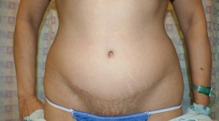 After photo of Tummy Tuck (Abdominoplasty) case 7 by Dr. Ramiro Morales, plastic surgeon in Miami, FL