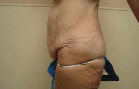 After photo of Tummy Tuck (Abdominoplasty) case 8 by Dr. Ramiro Morales, plastic surgeon in Miami, FL