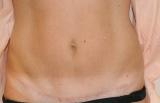 After photo of Tummy Tuck (Abdominoplasty) case 9 by Dr. Ramiro Morales, plastic surgeon in Miami, FL