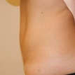 After photo of Tummy Tuck (Abdominoplasty) case 9 by Dr. Ramiro Morales, plastic surgeon in Miami, FL