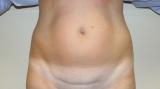 Before photo of Tummy Tuck (Abdominoplasty) case 9 by Dr. Ramiro Morales, plastic surgeon in Miami, FL