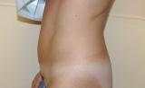 Before photo of Tummy Tuck (Abdominoplasty) case 9 by Dr. Ramiro Morales, plastic surgeon in Miami, FL