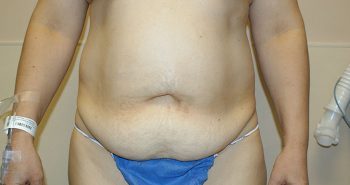 front-before4-qbks6zcmg5fh8199e5l12b8bdsapvx7qt0sipfmim2