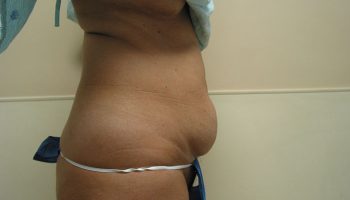 side-before1-qbks5tzq3fuy3oiz92ibao1jawq764g8dcwtw7b32o